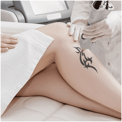 Laser Tattoo Removal