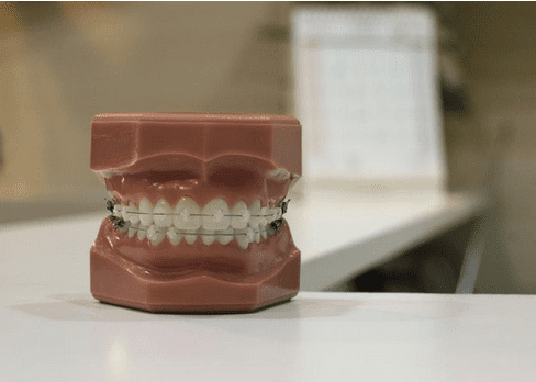 Dental Braces