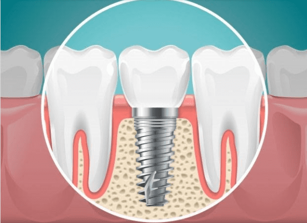 5 Tips to Prevent Dental Implant Infection