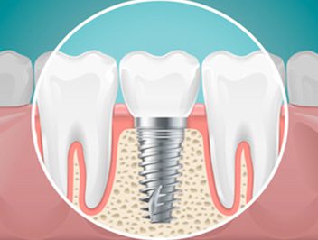 Best Clinics for Getting Dental Implants in Dubai