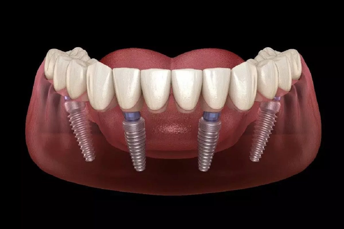 All-On-Four Dental Implants Procedure