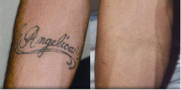 Common Tattoo Removal Treatments