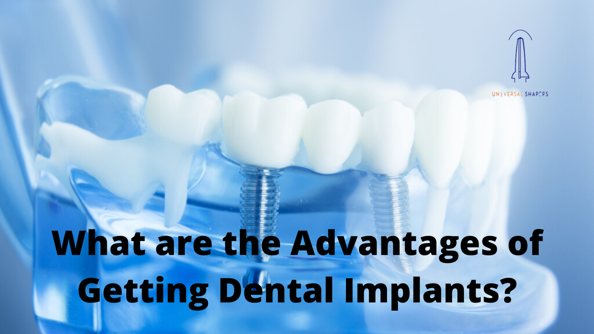 What are the Advantages of Getting Dental Implants?