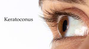 Keratoconus – Symptoms, Causes And Ayurvedic Treatment