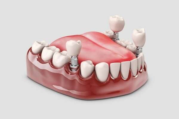 dental implants