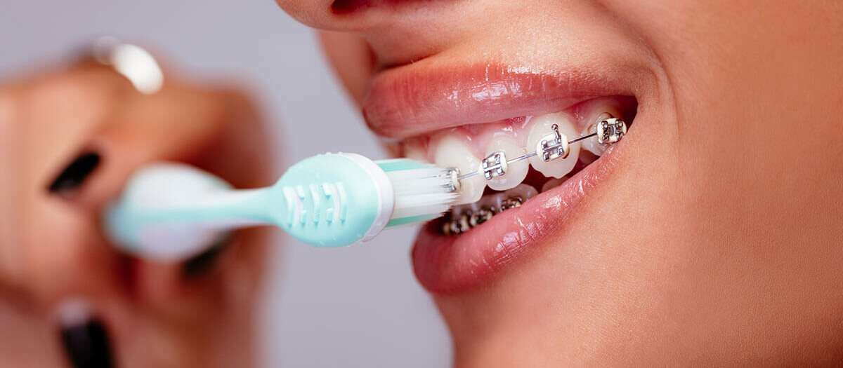 orthodontic braces