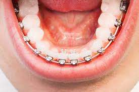 palate expander