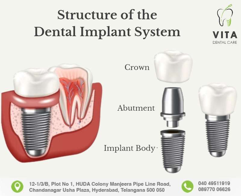 dental implants in chandanagar