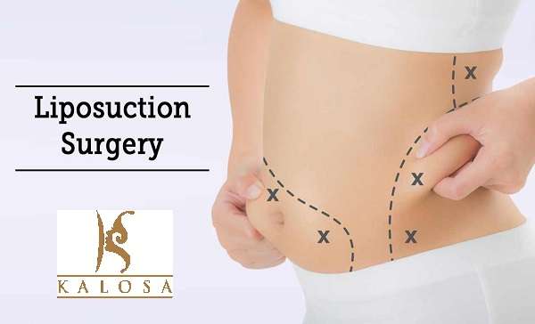 liposuction-surgery