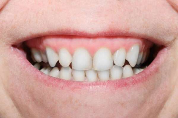 teeth whitening enamel