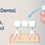 Types-of-Dental-Bridges-Materials,-Costs,-and-Lifespan