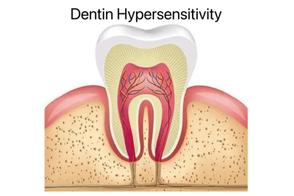 dentin hypersensetivity