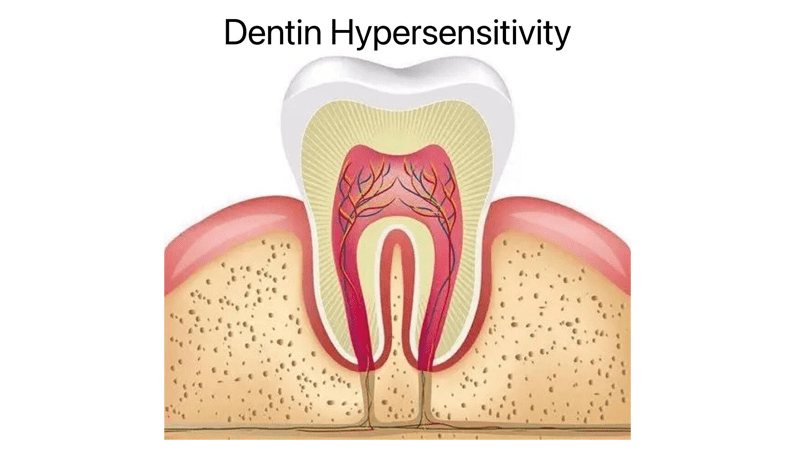 dentin hypersensetivity